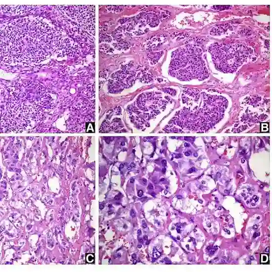 islet cell carcinoma